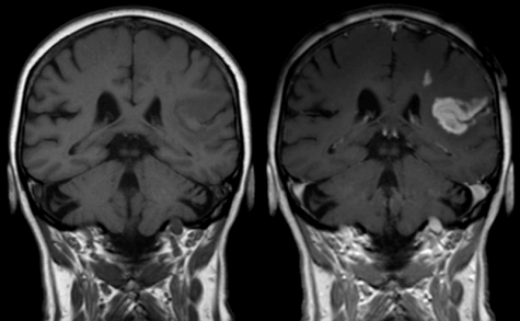 normal brain mri with contrast