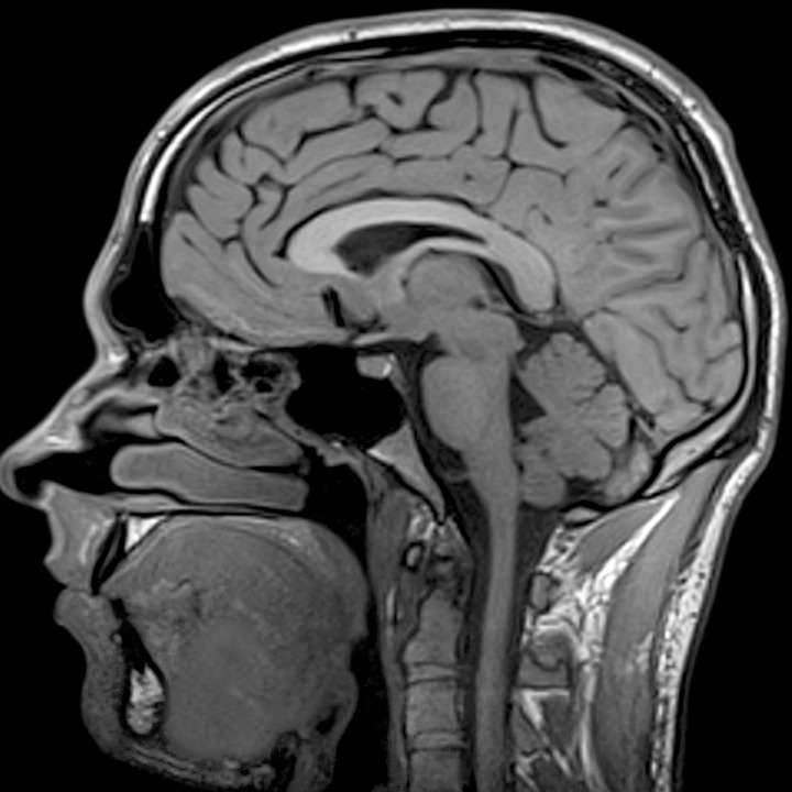 Head MRI | AffordableMRI.com