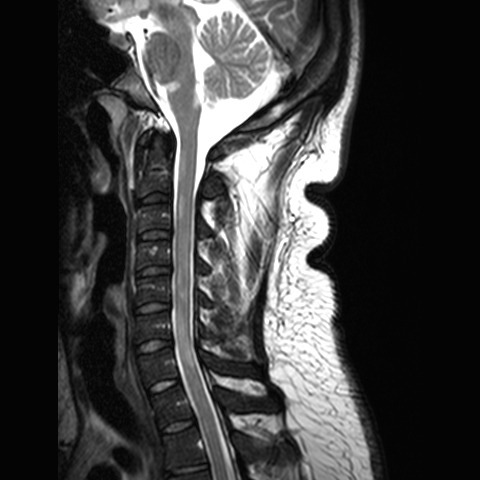 explain multiple sclerosis brain mri